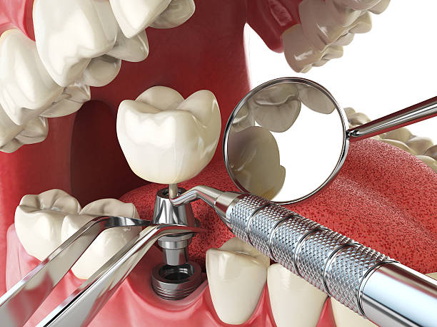 Best Emergency Dental Extractions in Fishersville, VA